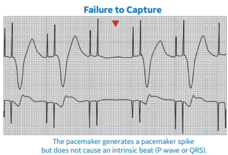 Arrhythmia Recognition Part 2 | Clinical View